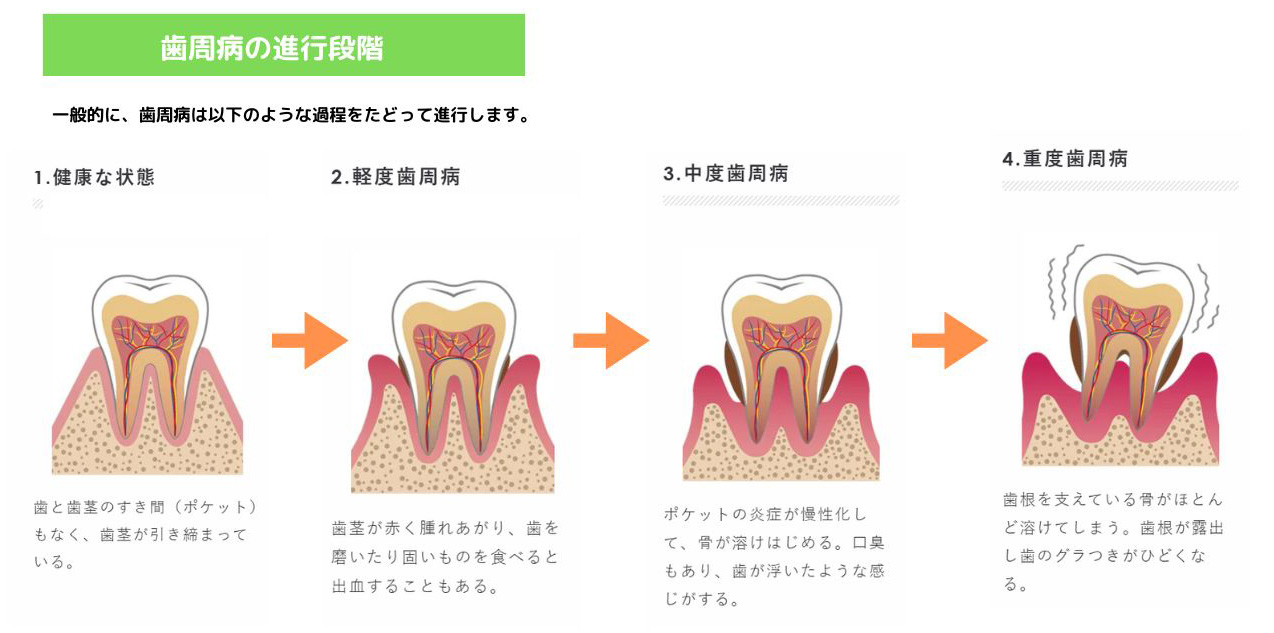 歯周病の進行段階